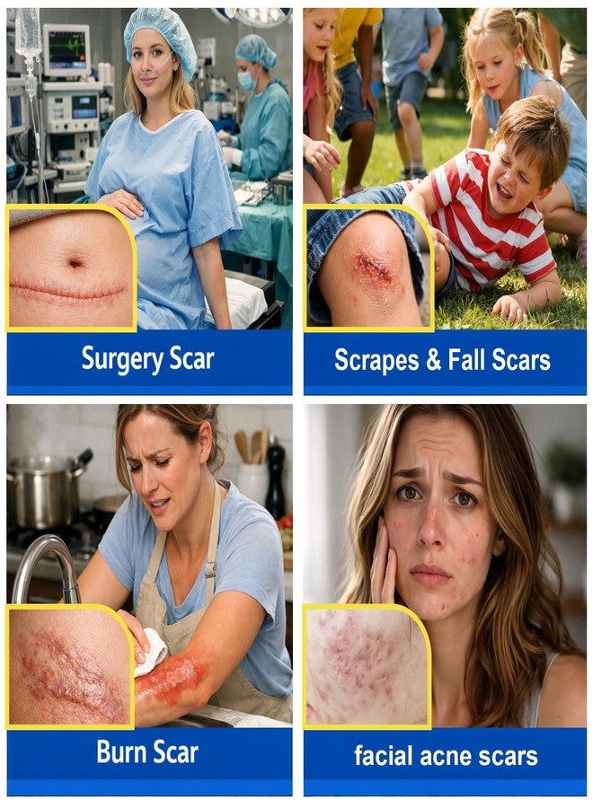 موروفان جل موروفان لإزالة الندبات بالسيليكون: كريم للندبات للجسم والوجه، يقلل بشكل فعال من ظهور الندبات الناتجة عن علامات التمدد، والندبات الجراحية، والجُدرات، وحب الشباب، والحروق، وغيرها. يُظهر الندبات الجديدة خلال 6 أسابيع. - Image 4